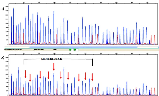 Fig. 1.  MLPA-detection of the MLH1 del.ex 3-12 mutation in a patient with the Lynch Syndrome (b) in comparison to a  control DNA sample (a).