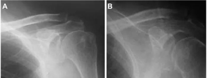 Fig. 3: Patient  demonstrating full range of movement of left shoulder without sign of impingement