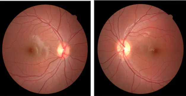 Figura 1- Retinografia OD e OE Caso Clínico 1 (Fotografia gentilmente cedida por CCECV da UBI)  Na realização da retinografia do OD, imagem da esquerda, foi observado uma relação C/D de 0.3, com  os bordos do disco ótico bem definidos, com coloração normal