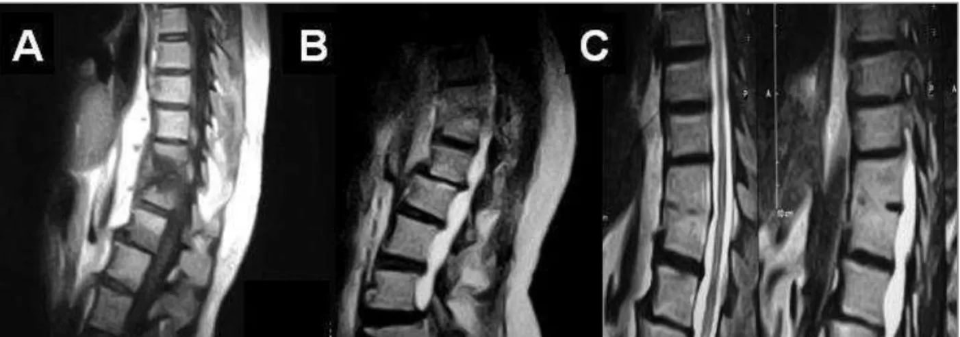 FIGURE 1. (A) Andersson lesion; (B) Parenchymal tissue in the canal; (C) Complete intravertebral fusion