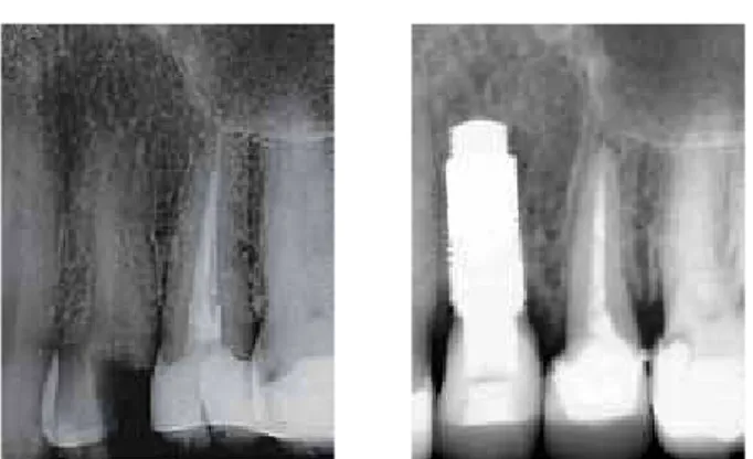 FiG. 1 a Fresh extraction socket  after atraumatic tooth extraction  before implant placement (a).