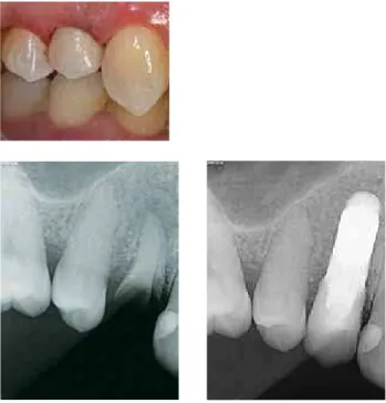 FiG. 3 G-H deinitive full ceramic restoration in lithium di-silicate was delivered  at 2 weeks