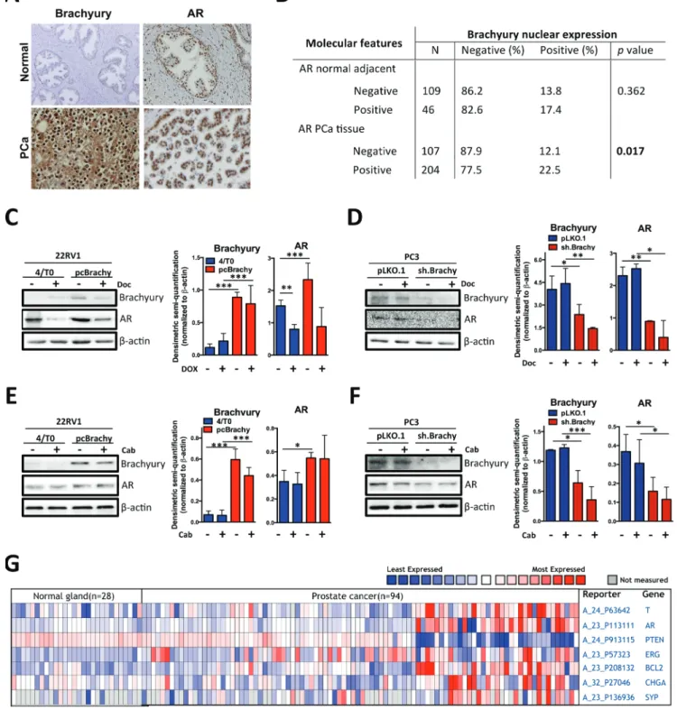 Figure 3: brachyury is associated with Ar, bcl-2, erG, cHGA and sYP expression and with loss of Pten expression