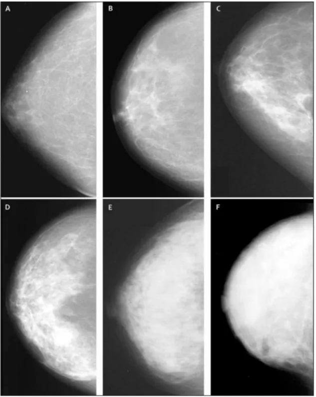 Figure 3- Examples of mamographic density (adapted from medscape) 