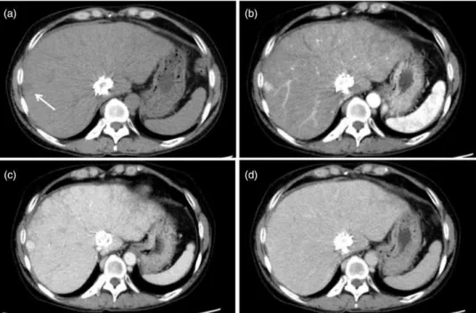 Fig. 2. Dynamic CT findings 2 years later from the time of CT shown in Fig. 1. (a) Unenhanced CT shows low-density nodule in the peripheral region of the liver (arrow)