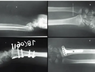 Fig. 2: a) preoperative radiographs showing intra articular distal end  radius  fracture  with  open  physis,  b)  intra  operative radiograph showing screws only proximal to fracture site, c) &amp; d) image intensifier views of reduced fracture using vola