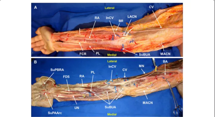 Figure 2 Right upper limb showing the anomalous course of the superficial brachioulnar artery in an above fascia (A) and a deeper to fascia (B) dissection
