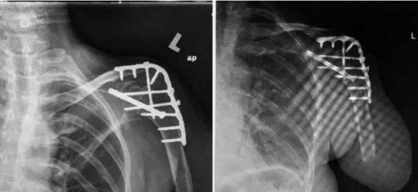 Fig. 2: General muscle wasting of left flail upper limb.