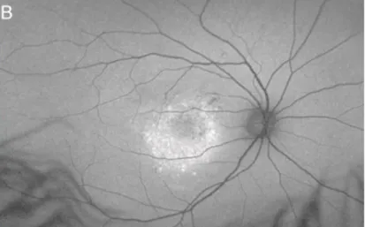 Figura 6 – Observação da área central de hiperautofluorescência que corresponde ao descolamento da  retina neuro-sensorial (13) 