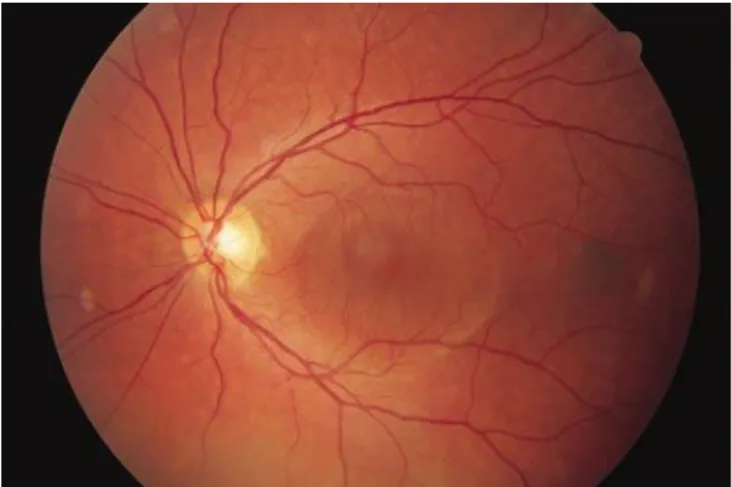 Figura 2.5 - Elevação ovalada da retina; (14) 