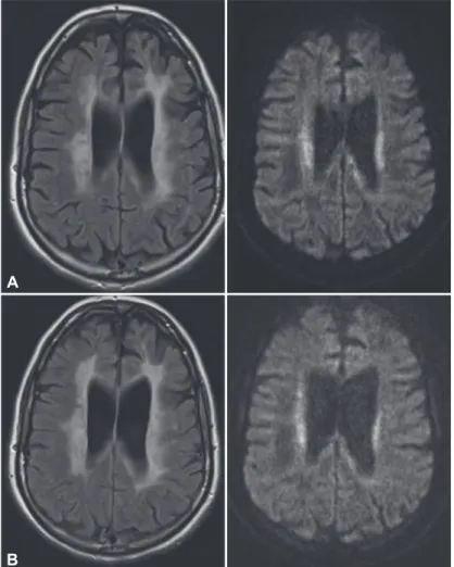 Figure 1.  Cerebral MRI at the irst visit (A) and nine months later (B). A: Cere - -bral MRI at the irst visit