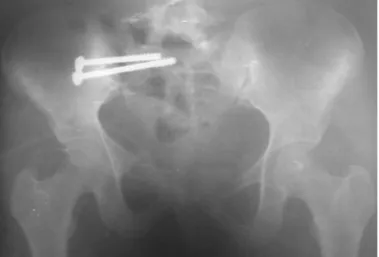 Fig. 1:  Unilateral  SI  joint  fixation  with  two  percutaneous cancellous screws.
