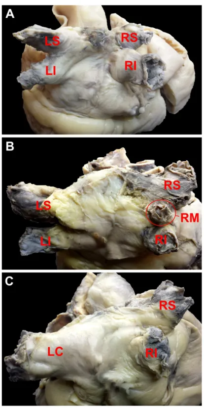 Figure 1 Photograph of cadaveric heart specimens with examples of pulmonary veins ostia patterns (view of the posterior and superior wall of the left atrium)