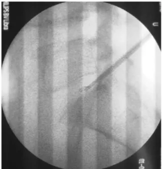 Fig. 2: Inability  to  remove  the  broken  micropituitary  tip  with via 3.0mm Disc-FX ® cannula.