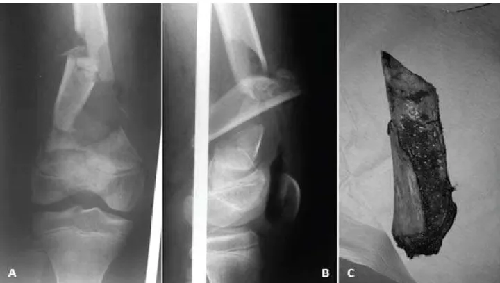 Fig. 3:  Radiographs  at  1  year  showing  incorporation  of  the graft with fracture union