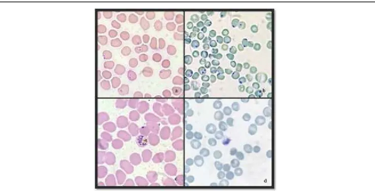 Fig.  1:  a)  Plasmodium  Falciparum  showing  Two  Rings  on  Leishman  Stain  b)  Plasmodium  Falciparum showing Two Chromatin Dots on New Methylene Blue Stain c) Schizonts of Plasmodium  Vivax  on  Leishman  Stain  d)  Schizonts  of  Plasmodium  Vivax  