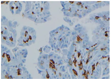 Fig. 2. Morphologies of CD68-positive tumor-associated macro- macro-phages (TAMs) in papillary thyroid carcinomas (PTCs)
