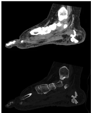 FIGURE 2. Computed-tomography image with an exuberant conglomerate of calcifications in the medial aspect of plantar fat pad associated with subcutaneous oedema