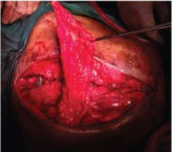 Fig. 4: Shows  the  lower  aspect  of  the  trapezius  loosely  suture  over  the  subcutaneous  to    cover  the   implant.