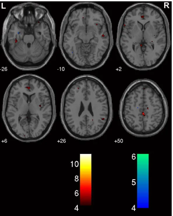 Figure 3. Spatial parametric BOLD activation maps for MR condition contrast spatial  vs