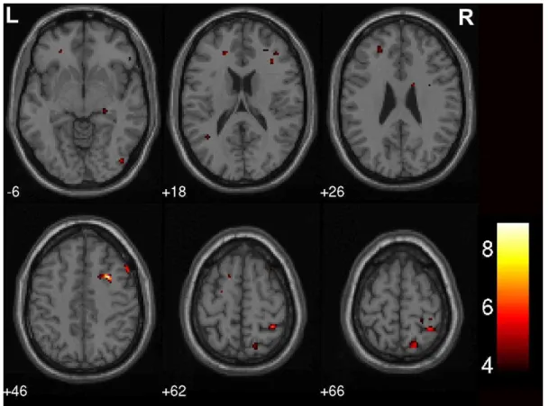 Figure 4. Spatial parametric BOLD activation maps for MR condition contrast spatial  vs