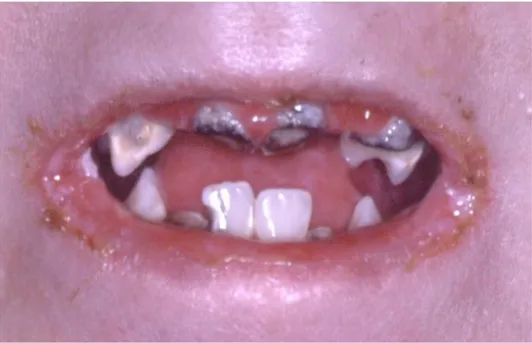 Figura 8 – Paciente portador de EBDr generalizada severa com microstomia e  pseudosindactilia a escovar os dentes (Kämer, 2010) 