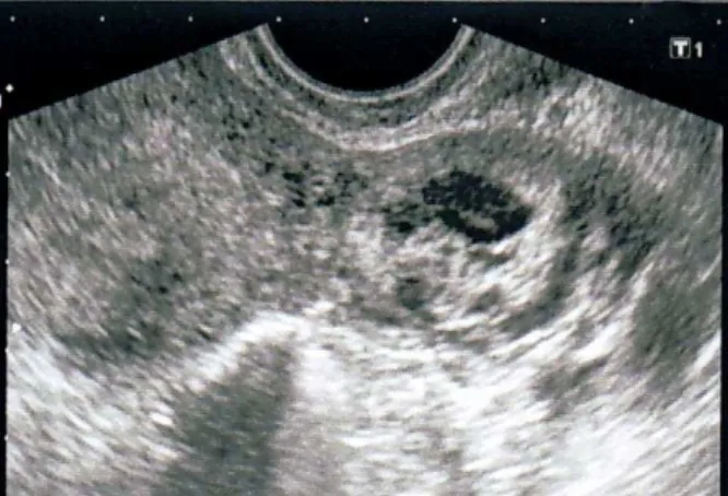 Fig. 2 – Ultrasound image of early retroperitoneal  pregnancy in the left broad ligament: a round cystic mass,  filled with a heterogeneous content and the hypoechogenic  structure inside, like a gestational sac without fetal pole