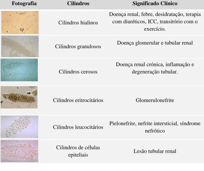 Tabela 8. Cilindros que podem ser observadas num sedimento urinário e o seu  significado clínico (Adaptado de [91]) .