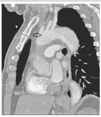 Abbildung 10: CT-Angiographie des Aortenbogens mit Darstellung des proximalen  Dissektats (Pfeil).