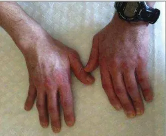 FIGure 2. Erythematous cutaneous lesions overlying the 2 nd , 3 th and 4 th metacarpophalangeal joints