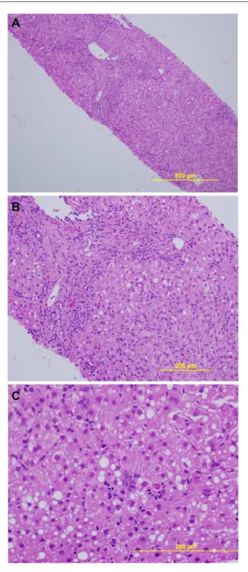 Figure 1.  Liver biopsy. In (A) is shown liver stained with  hematoxylin and eosin, revealing an inflammatory infiltrate  primarily in the portal tract (upper left side of the image)