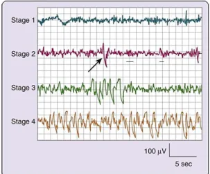 Figura 4.2 Atividade EEG característica de cada um dos  4 estadios do sono NREM. Nota: na fase 2, a seta indica  um complexo K e o sublinhado mostra 2 fusos de sono (5) 