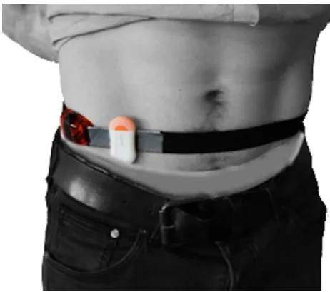 Figure 1 Accelerometer placement. ActiGraph is placed laterally to the right SIAS and the Motion Cookie is placed medially (Randomization 1).