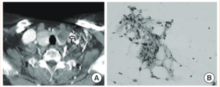 Fig. 1. Chest computed tomography (CT) at initial diagnosis and  final pathology after initial surgery