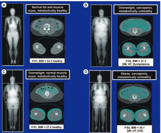 Fig. 2. Magnetic resonance imaging scans comparing the distributions of abdominal and thigh fat and muscle in (A) lean, (B, C) over- over-weight, and (D) obese women
