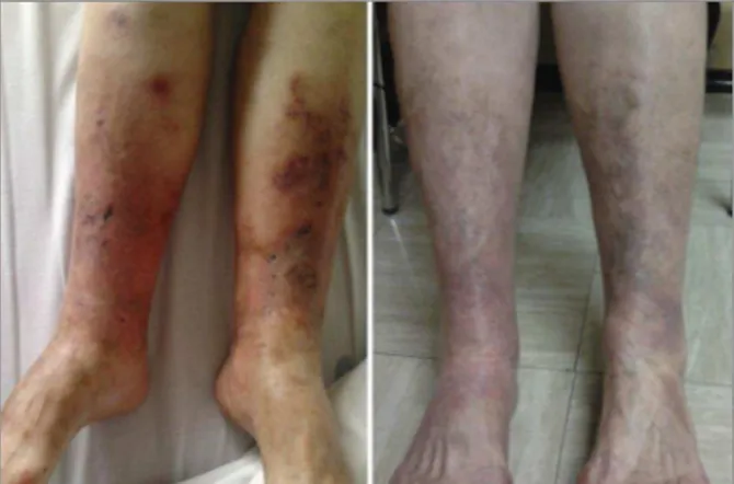 FIGURE 1. Cutaneous lesions (left) before and (right) one year after treatment with Rituximab
