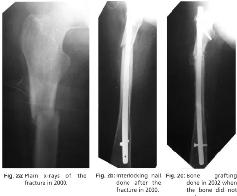 Fig. 2a: Plain  x-rays  of  the fracture in 2000.