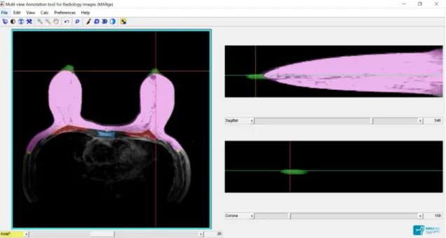 Figure 4.3: MARge Software. Pink: breast contour; Green: nipple; Red: pectoral muscle; Yellow: