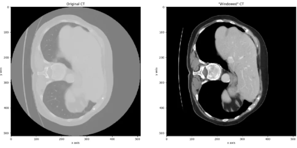 Figure 3.5: Left: Original CT. Right: &#34;Windowed CT&#34;.