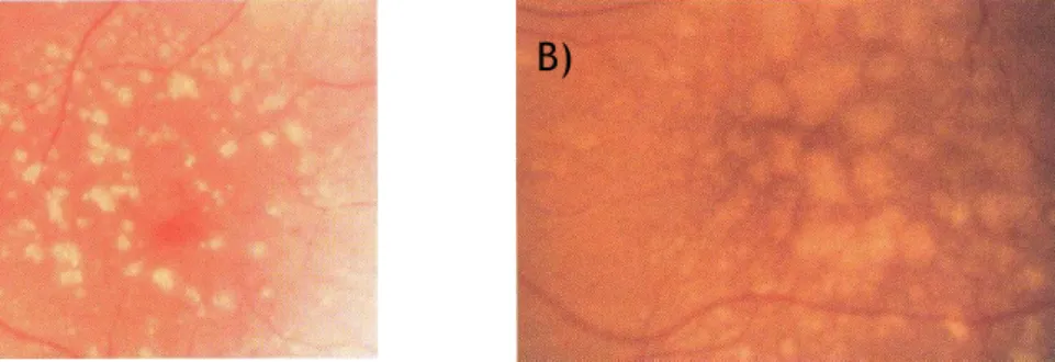 Figura 5 - A) Drusas duras; B) Drusas moles