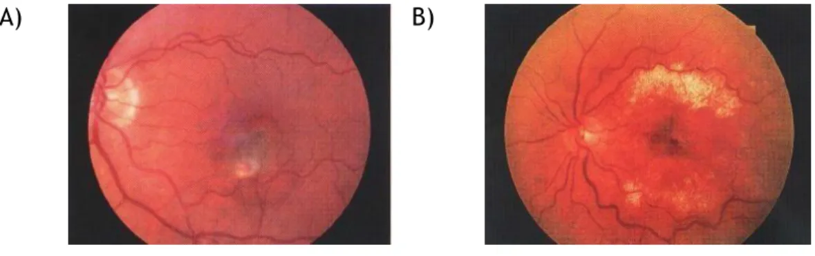 Figura 9-A) Elevação serosa da retina; B) Exsudatos duros e hemorragias associadas neovascularização da  coroide 