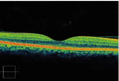 Figura 4 – Imagem do OCT de uma retina normal. 12