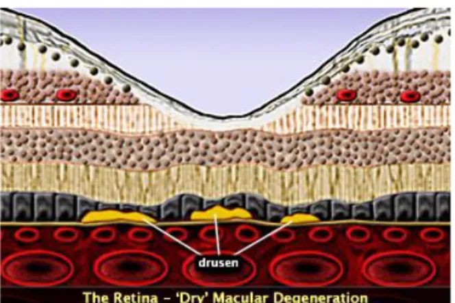 Figura  4  Corte  transversal  da  retina  ilustrando  uma situação de DMRI atrófica.  