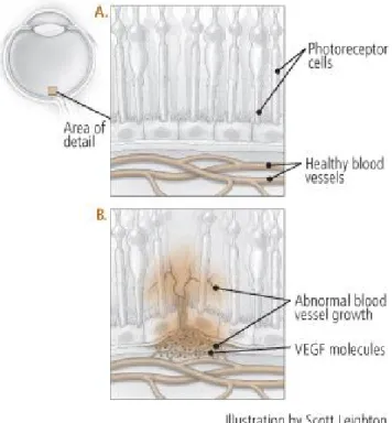 Figura 7 Factor de Crescimento Endotelial Vascular e proliferação de neovasos.