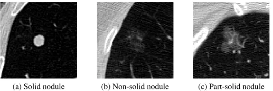 Figure 2.5: Lung nodules from [4], representing solid, non-solid, and part-solid densities, in axial view.