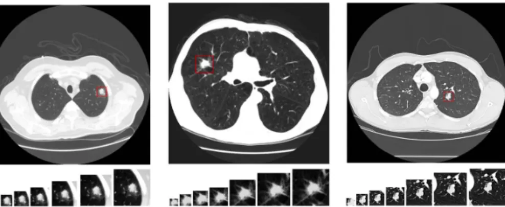 Figure 3.10: CT examples of the three types of ternary classification (from left to right, benign, primary malignant and metastatic malignant) with, in each one, the different 7 different views areas, from left to right 20x20, 30x30, 40x40, 50x50, 60x60, 7