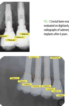fig. 9  Crestal bone resorption evaluated on digitized periapical  radiographs of transmucosal implants after 6 years.