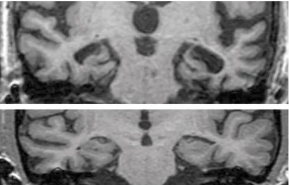 Ilustração 3 - RM de um doente com DA e outro com DCL pareados pela gravidade clínica da demência