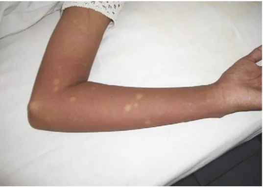 Figura  12. Exantema  máculo-papular  causado  pelo  vírus  do  Dengue  com  zonas  de  pele  integra