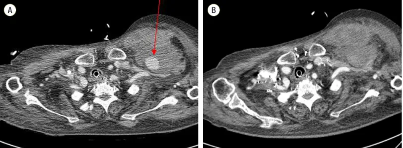 Fig. 2. An ultrasound-guided thrombin injection was performed at the pseudoaneurysm of the left subclavian artery (A: pre-injection, B: 